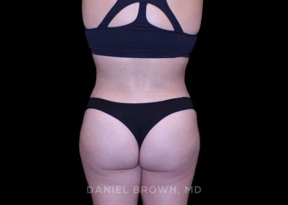 Tummy Tuck Before & After Patient #11000