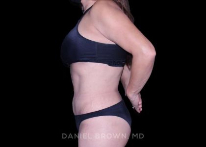 Tummy Tuck Before & After Patient #11000