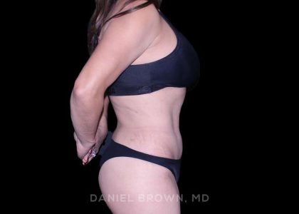 Tummy Tuck Before & After Patient #11000