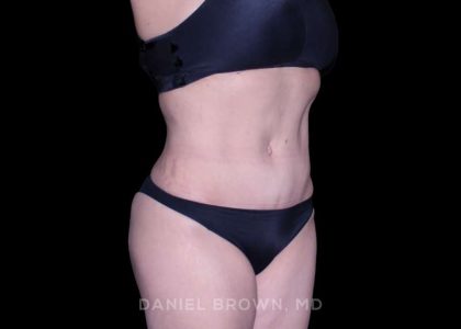Tummy Tuck Before & After Patient #11000