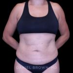 Tummy Tuck Before & After Patient #11000