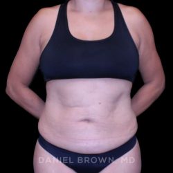 Tummy Tuck Before & After Patient #11000