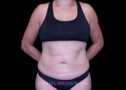 Tummy Tuck Before & After Patient #11000