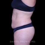 Tummy Tuck Before & After Patient #11000