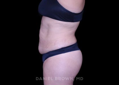 Tummy Tuck Before & After Patient #11000