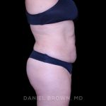 Tummy Tuck Before & After Patient #11000