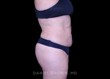 Tummy Tuck Before & After Patient #11000