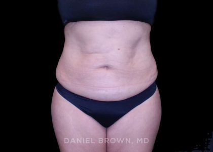 Tummy Tuck Before & After Patient #11000