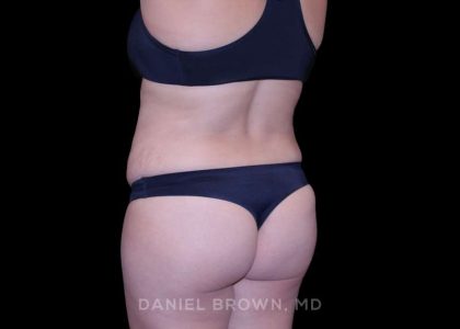 Tummy Tuck Before & After Patient #11000