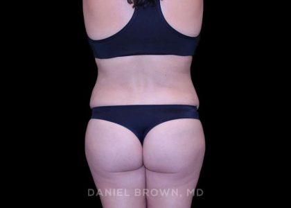 Tummy Tuck Before & After Patient #11000