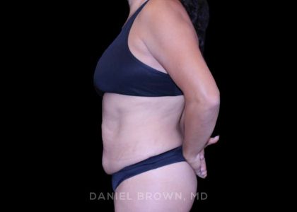 Tummy Tuck Before & After Patient #11000