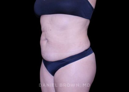 Tummy Tuck Before & After Patient #11000