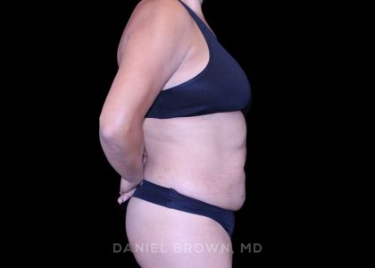 Tummy Tuck Before & After Patient #11000
