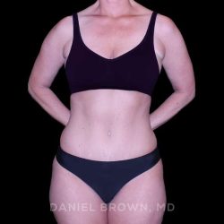 Tummy Tuck Before & After Patient #11023