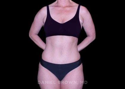 Tummy Tuck Before & After Patient #11023