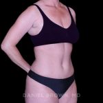 Tummy Tuck Before & After Patient #11023