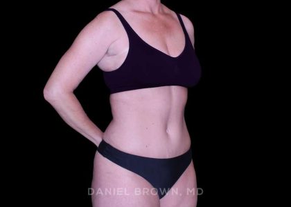 Tummy Tuck Before & After Patient #11023