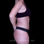 Tummy Tuck Before & After Patient #11023