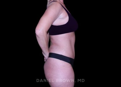 Tummy Tuck Before & After Patient #11023