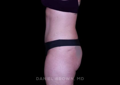 Tummy Tuck Before & After Patient #11023