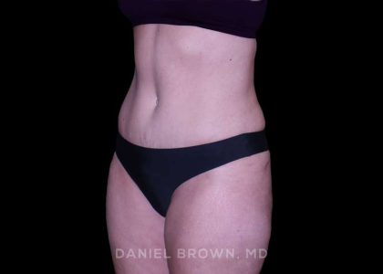 Tummy Tuck Before & After Patient #11023