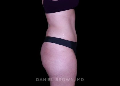 Tummy Tuck Before & After Patient #11023