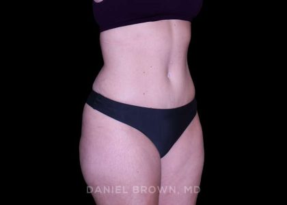 Tummy Tuck Before & After Patient #11023
