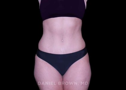 Tummy Tuck Before & After Patient #11023