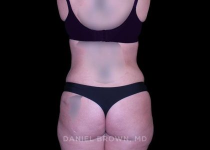 Tummy Tuck Before & After Patient #11023