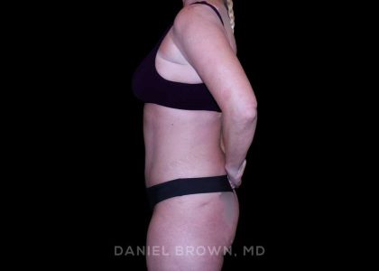 Tummy Tuck Before & After Patient #11023