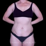 Tummy Tuck Before & After Patient #11023