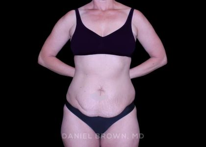 Tummy Tuck Before & After Patient #11023