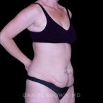 Tummy Tuck Before & After Patient #11023
