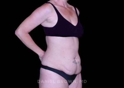 Tummy Tuck Before & After Patient #11023
