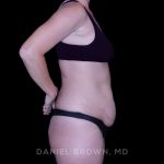 Tummy Tuck Before & After Patient #11023