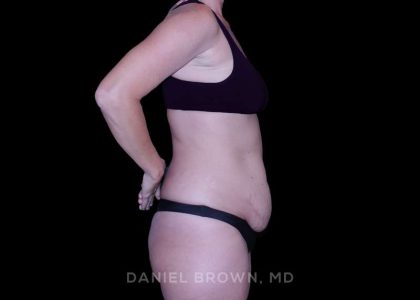 Tummy Tuck Before & After Patient #11023