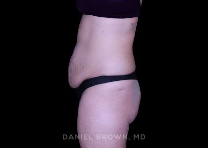 Tummy Tuck Before & After Patient #11023
