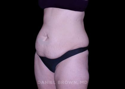 Tummy Tuck Before & After Patient #11023