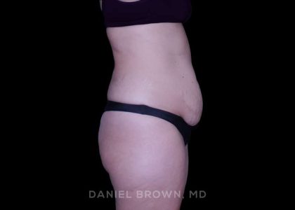 Tummy Tuck Before & After Patient #11023