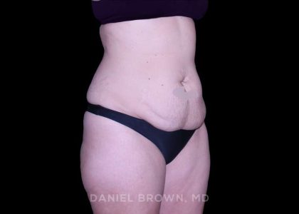 Tummy Tuck Before & After Patient #11023