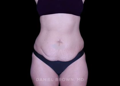 Tummy Tuck Before & After Patient #11023