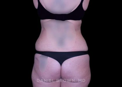 Tummy Tuck Before & After Patient #11023