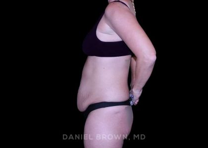 Tummy Tuck Before & After Patient #11023