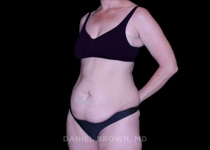 Tummy Tuck Before & After Patient #11023