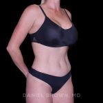 Tummy Tuck Before & After Patient #11050