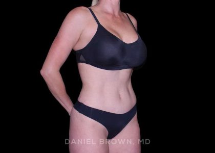 Tummy Tuck Before & After Patient #11050