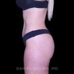 Tummy Tuck Before & After Patient #11050