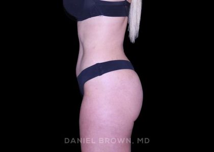 Tummy Tuck Before & After Patient #11050