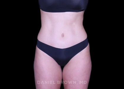 Tummy Tuck Before & After Patient #11050
