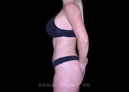 Tummy Tuck Before & After Patient #11050
